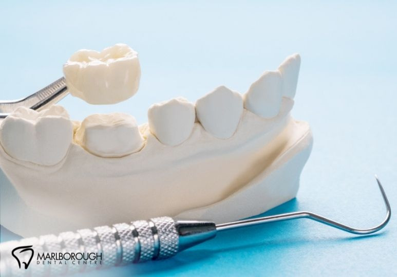 Dental Crowns vs. Bridges: What’s the Best Option for You?